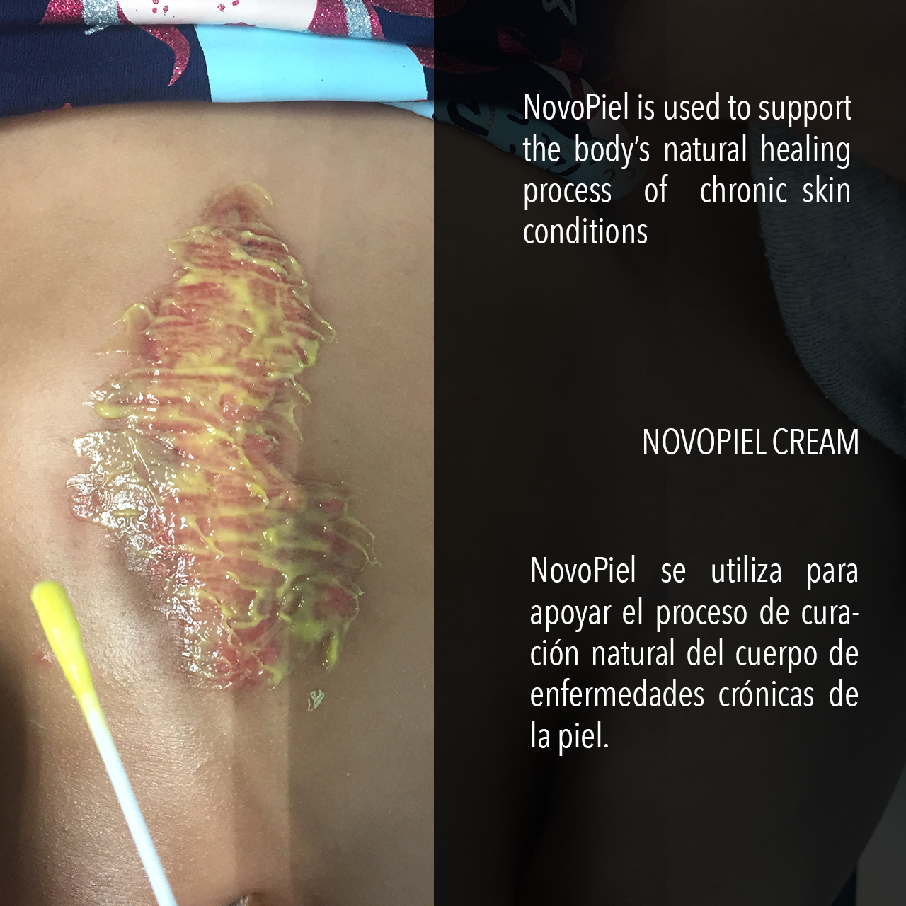 Novopiel Cream